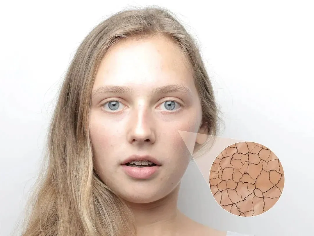 Dry Skin or Dehydrated Skin? Key Differences and Care Tips - The Purest Solutions | Skincare that actually works