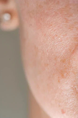 What Are Pores and How Can You Minimize Them?