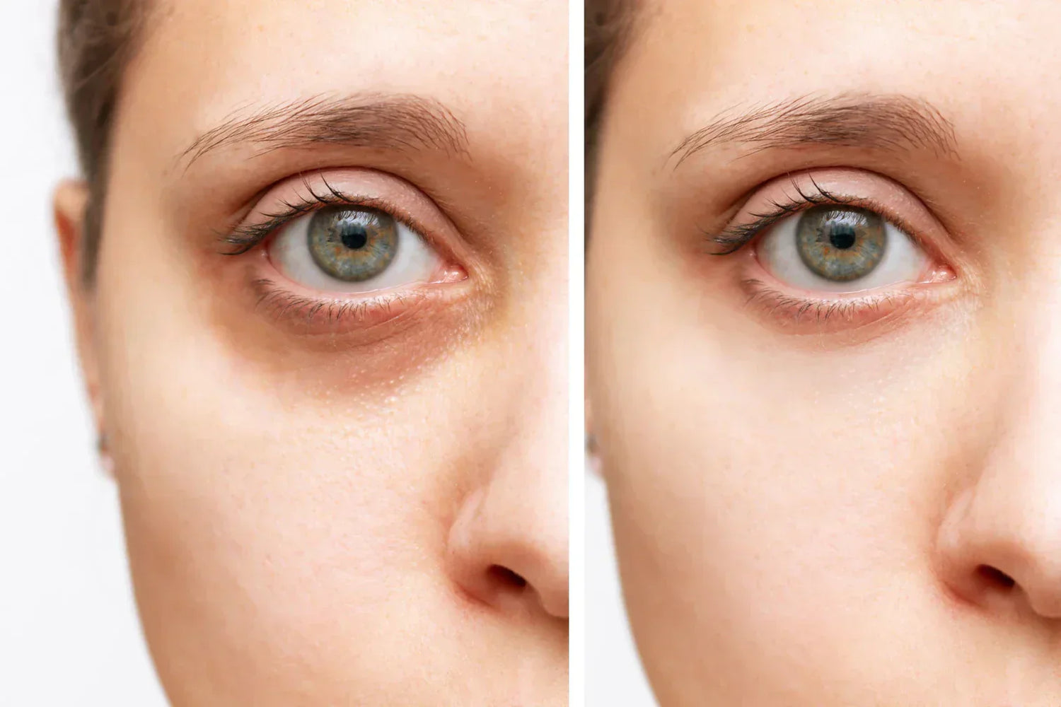 How to Get Rid of Under-Eye Bags and Dark Circles?