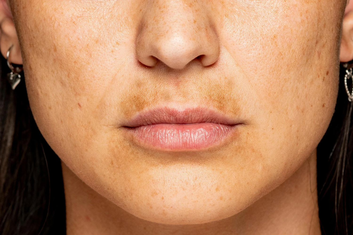 What Is Uneven Skin Tone?
