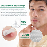 Microneedle Technology Acne Patches